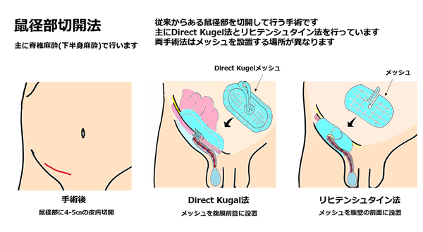 hernia.topix1-5.png