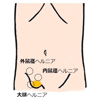 hernia.topix1-1.jpg