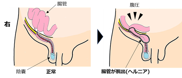 hernia.topix1-2.png