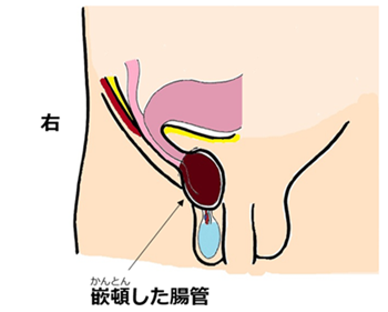 hernia.topix1-3.png