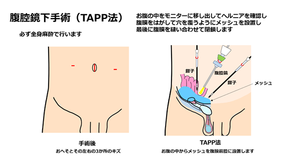 hernia.topix1-6.png