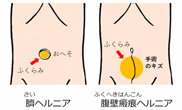 hernia.topix2-1.png