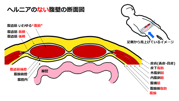 hernia.topix2-2.png