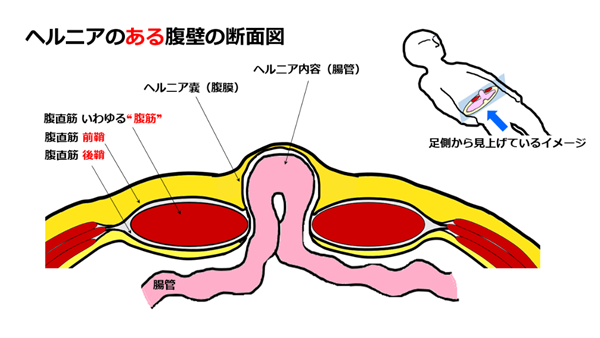 hernia.topix2-3.png
