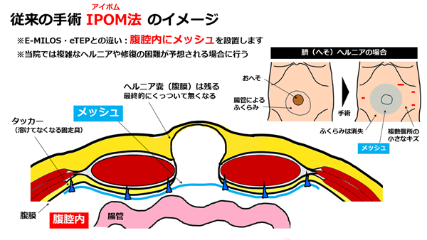 hernia.topix2-5.png