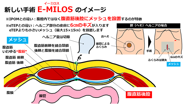 hernia.topix2-6.png