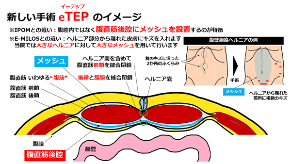 hernia.topix2-7.png